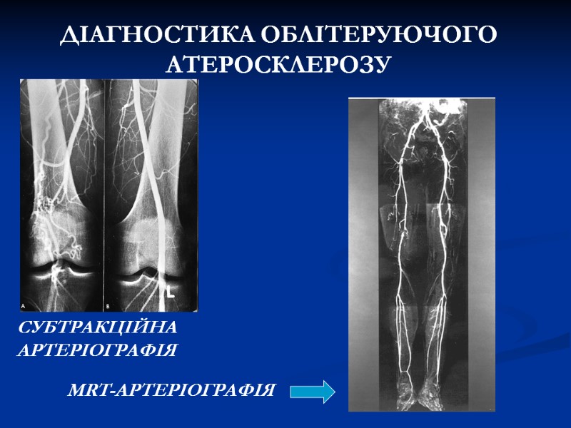 ДІАГНОСТИКА ОБЛІТЕРУЮЧОГО АТЕРОСКЛЕРОЗУ СУБТРАКЦІЙНА АРТЕРІОГРАФІЯ MRT-АРТЕРІОГРАФІЯ ДІАГНОСТИКА ОБЛІТЕРУЮЧОГО АТЕРОСКЛЕРОЗУ СУБТРАКЦІЙНА АРТЕРІОГРАФІЯ MRT-АРТЕРІОГРАФІЯ
